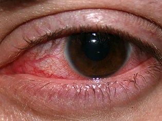 Keratitis in the eye